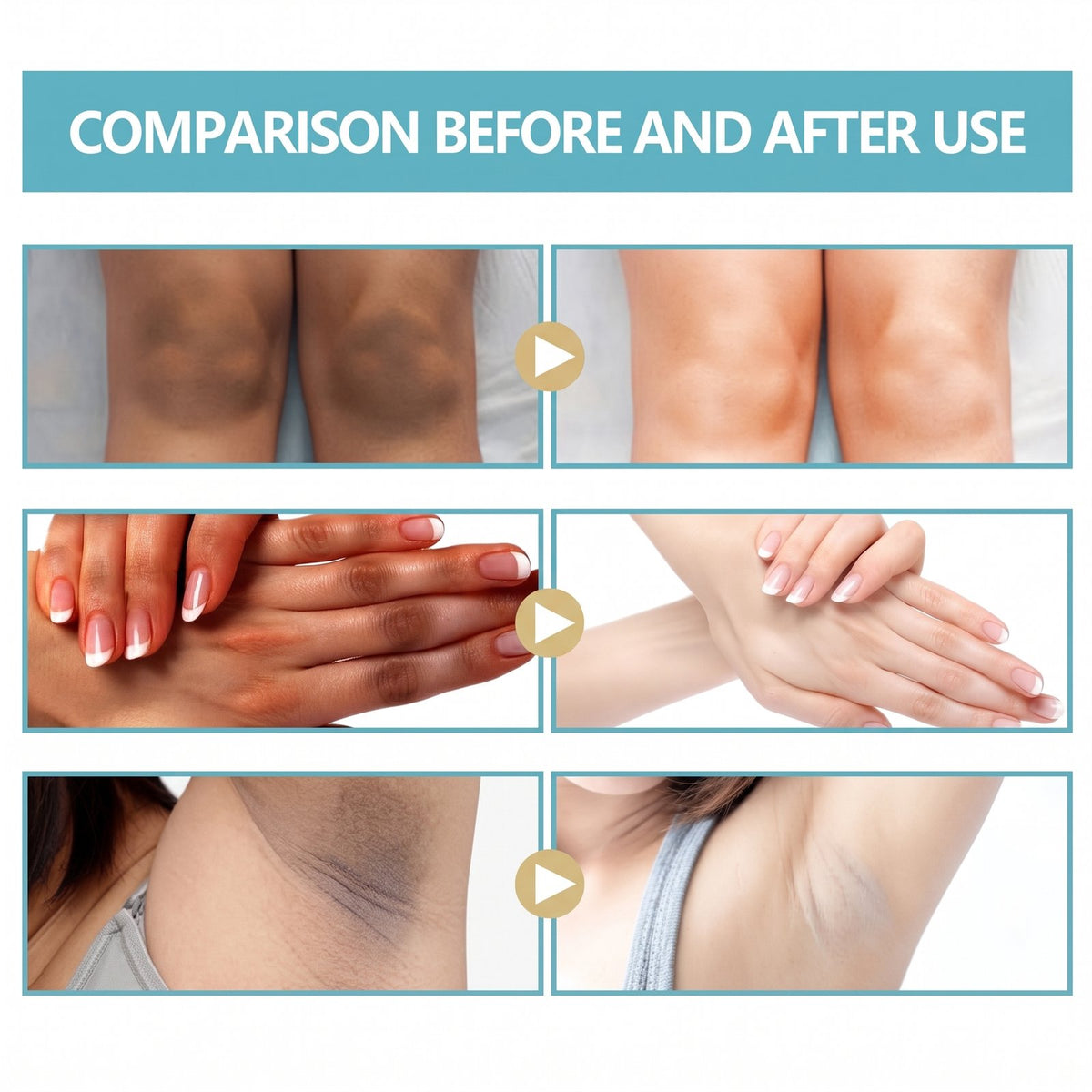 Acanthosis Nigricans Therapy Cream 50g