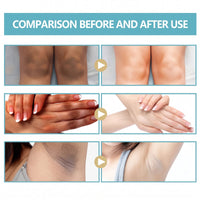 Acanthosis Nigricans Therapy Cream 50g